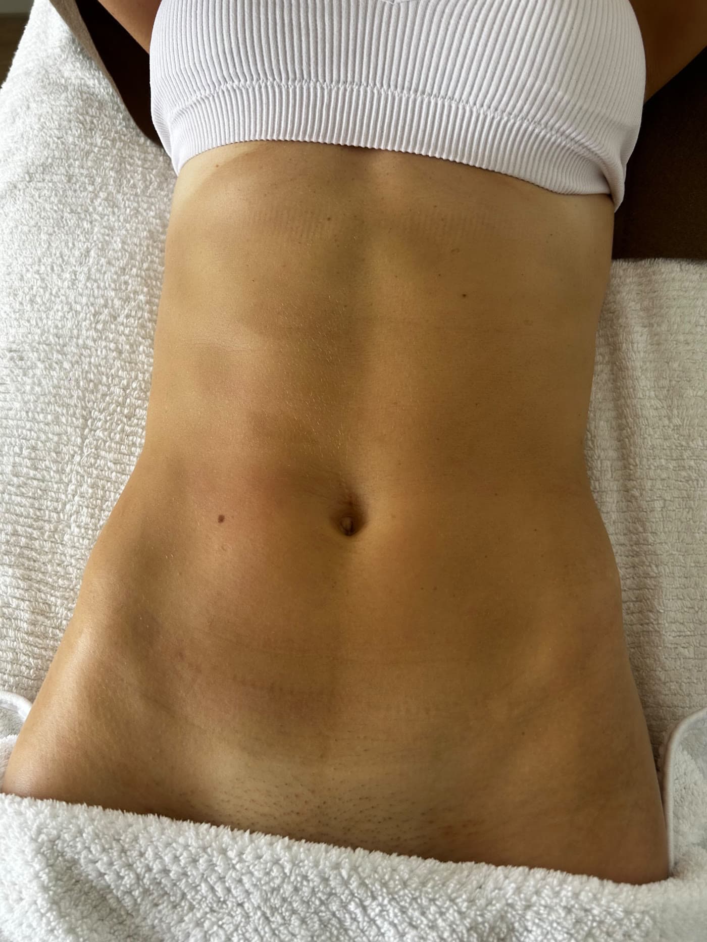 Abdomen en una sesión de drenaje, sobre toalla blanca