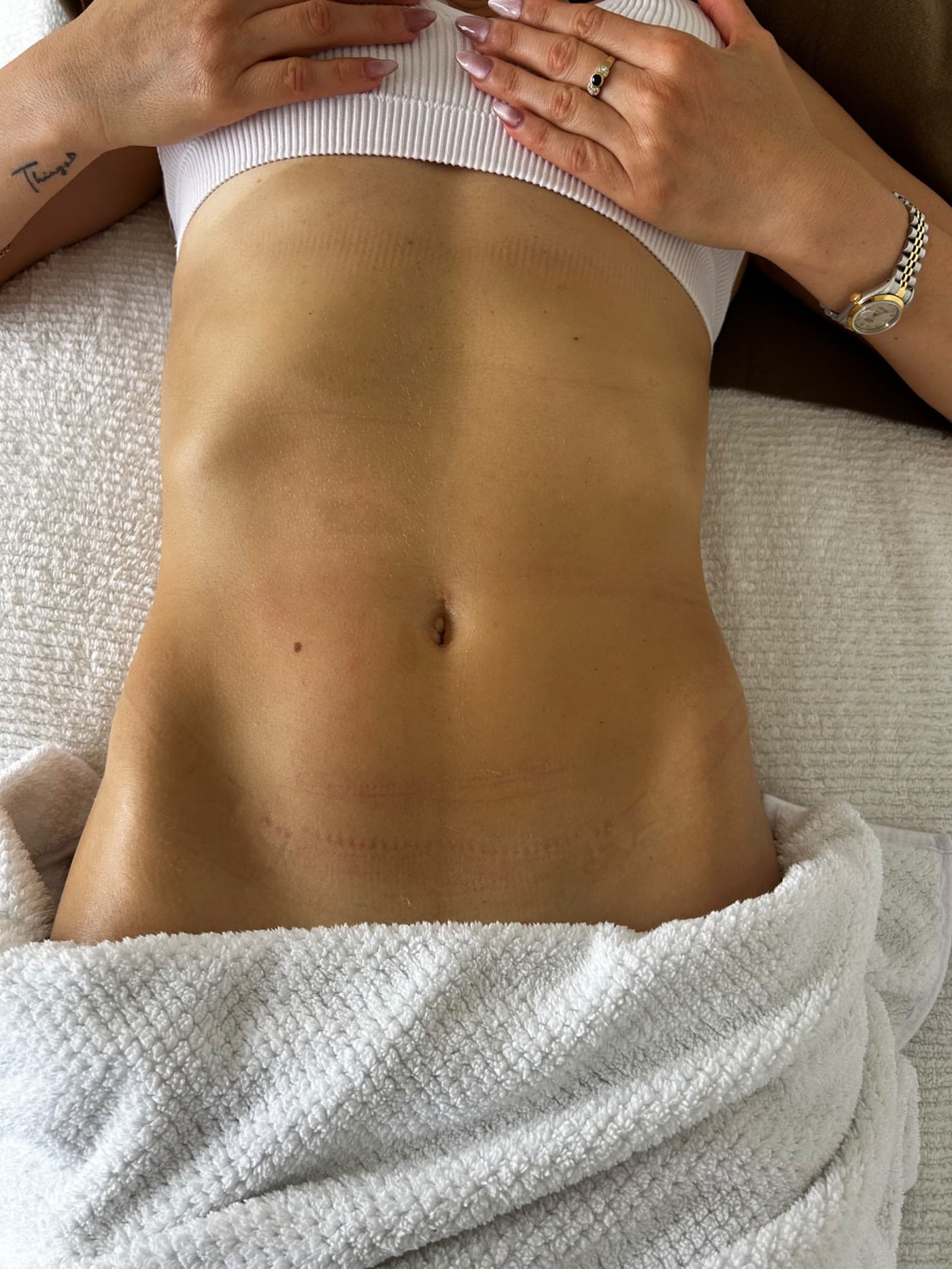 Manos trabajando un drenaje abdominal